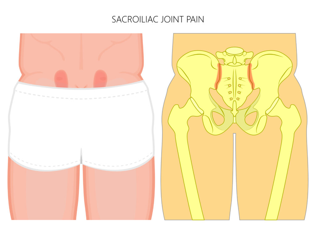 Sacroiliac joint pain
